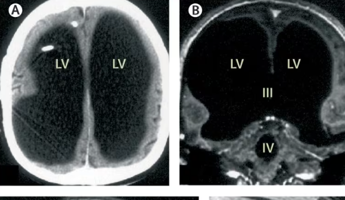 Man Found to Be Missing 90% of His Brain but Still Living a Normal Life