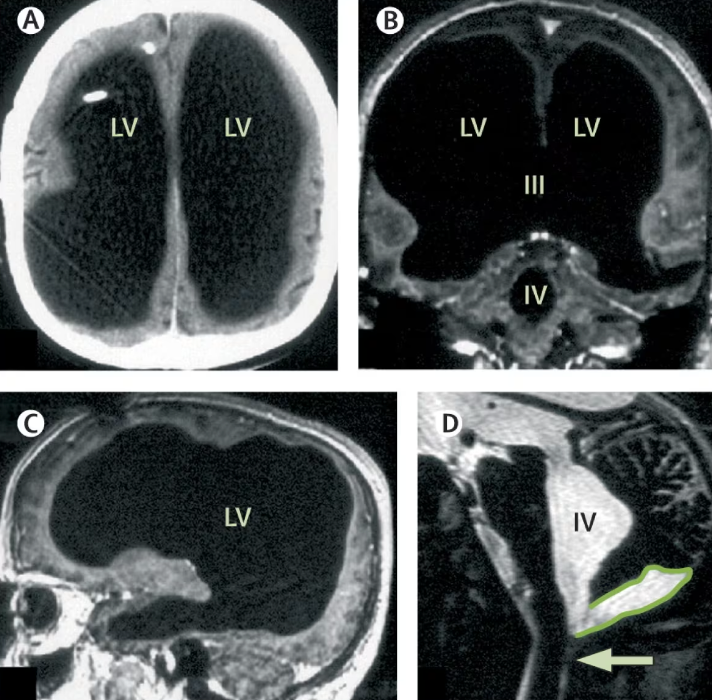 Man Found to Be Missing 90% of His Brain but Still Living a Normal Life